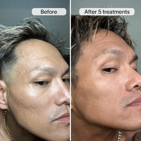 PDRN Micro Infusion System