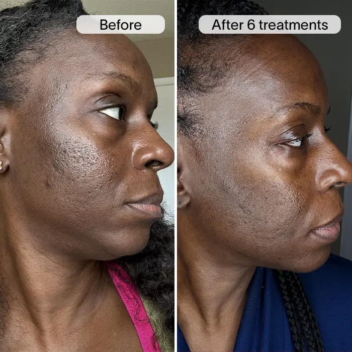 PDRN Micro Infusion System